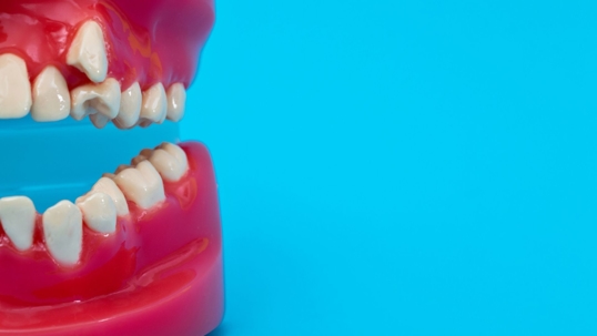 Photo of a 3D mouth rendering with impacted canines.