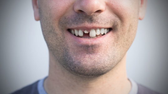 Man with chipped tooth