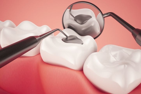 Illustration of a dental filling
