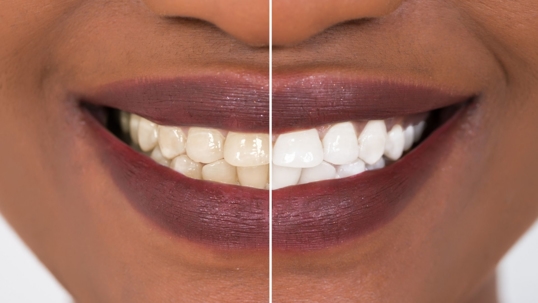 Photo of a person's smile, with the right side of the photo showing whitened teeth.