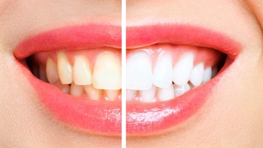 Teeth whitening