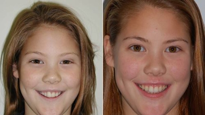Pediatric Invisalign Photo