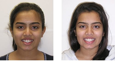 Invisalign Before & After
