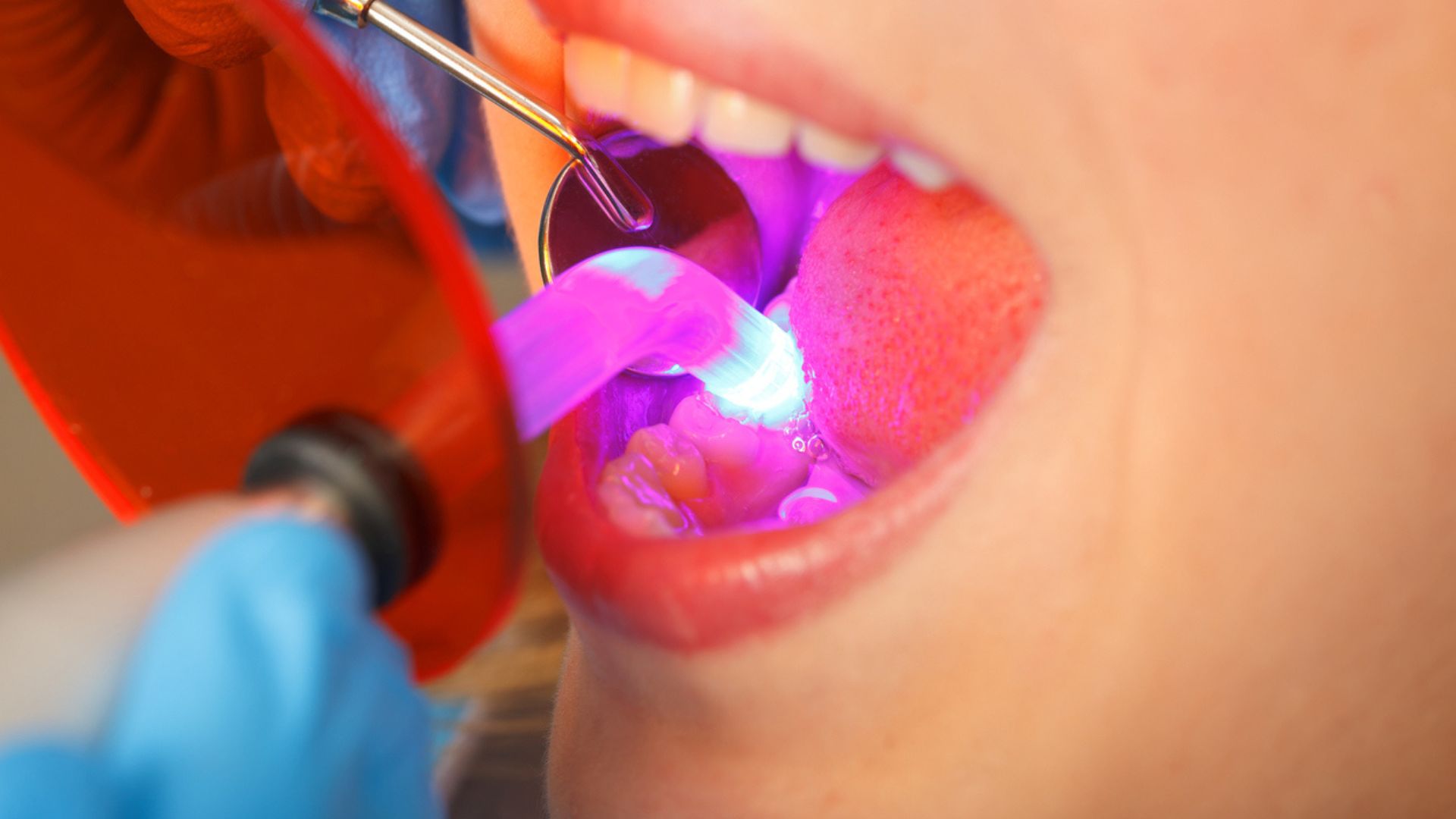 What Is Dental Bonding and How Can It Benefit My Oral Health?