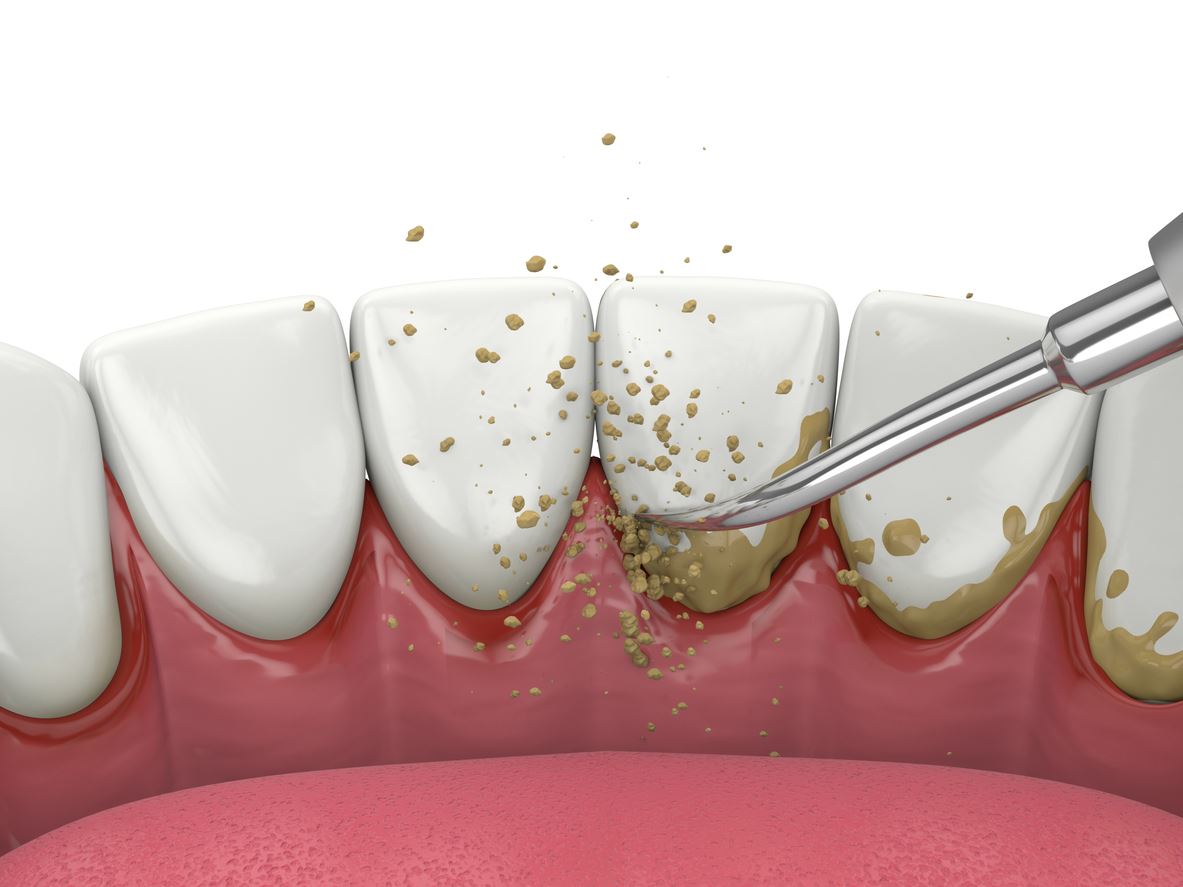 What Is Plaque and How Can It Harm My Teeth?